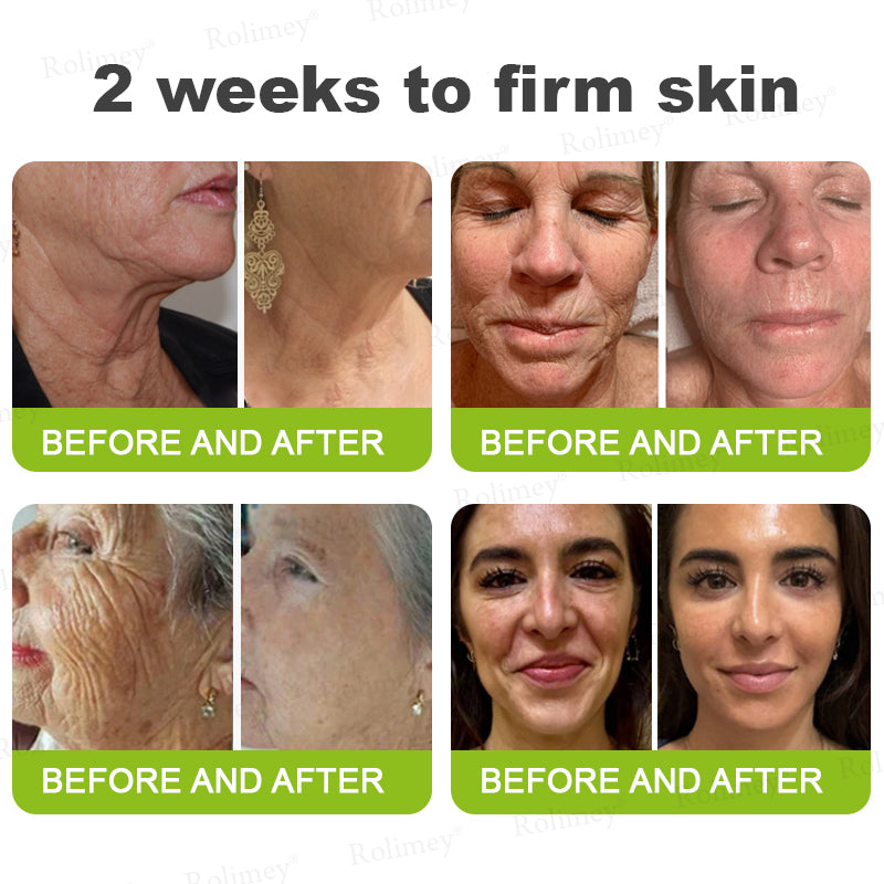 up-[🔥Last Day 70% OFF] ODALIT™ Botox & Retinol Shot - Eraser for Deep Wrinkles, Sagging Jowls & Puffy Eyes