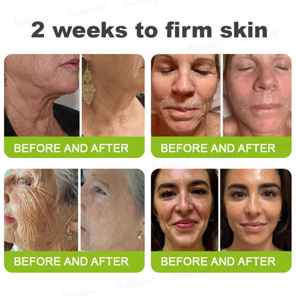 up-[🔥Last Day 70% OFF] ODALIT™ Botox & Retinol Shot - Eraser for Deep Wrinkles, Sagging Jowls & Puffy Eyes