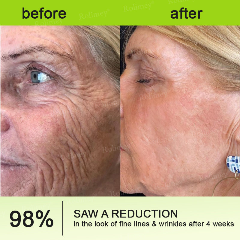 up-[🔥Last Day 70% OFF] ODALIT™ Botox & Retinol Shot - Eraser for Deep Wrinkles, Sagging Jowls & Puffy Eyes