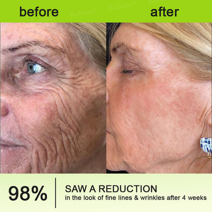up-[🔥Last Day 70% OFF] ODALIT™ Botox & Retinol Shot - Eraser for Deep Wrinkles, Sagging Jowls & Puffy Eyes